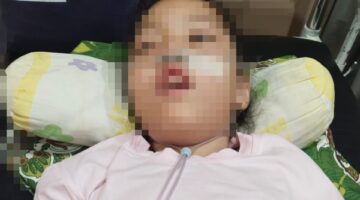 Menahun Derita Penyakit Otak, Balita 4 Tahun Asal Aceh Tenggara, Butuh Bantuan Pemerintah